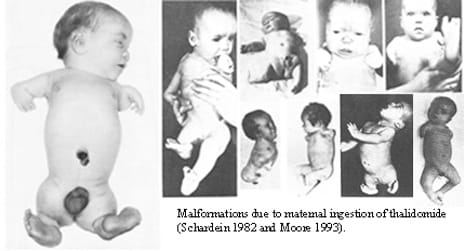 Thalidomide effects -Bangalore Clinical Research Institute